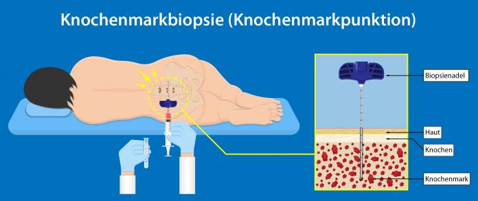 Knochenmarkbiopsie (Knochenmarkpunktion)