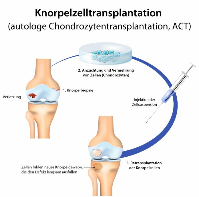 Knorpelzelltransplantation (ACT)