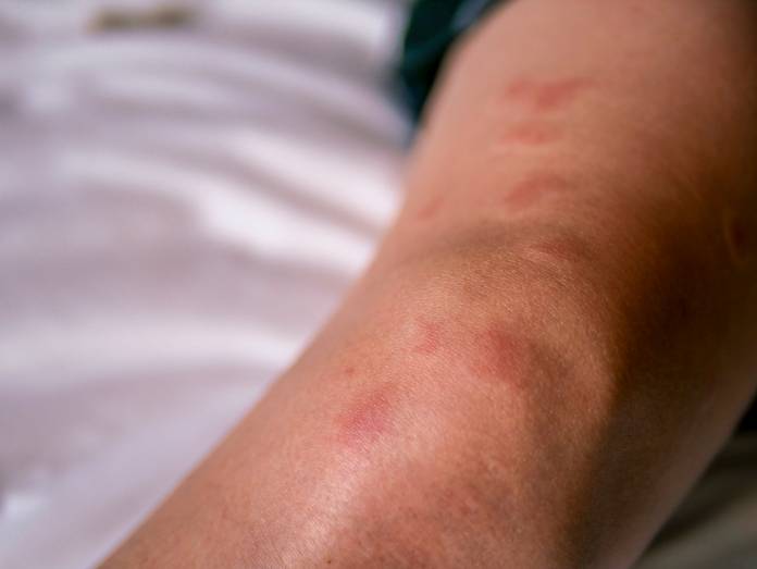 Systemic lupus erythematosus (sle) is the form of lupus that can harm your skin, joints, kidneys and brain and may be fatal. Kollagenosen Bindegewebserkrankungen
