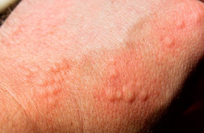 Kontaktdermatitis, Kontaktekzem, Kontaktallergie