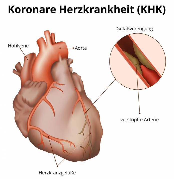Koronare Herzkrankheit (KHK)