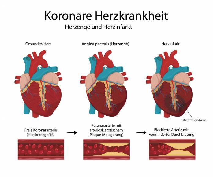 Koronare Herzkrankheiten