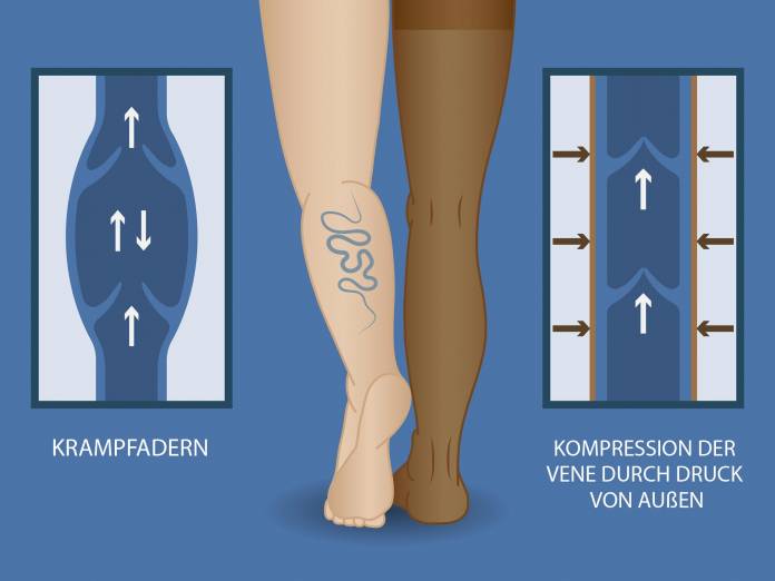 Kompressionsstrümpfe bei Krampfadern