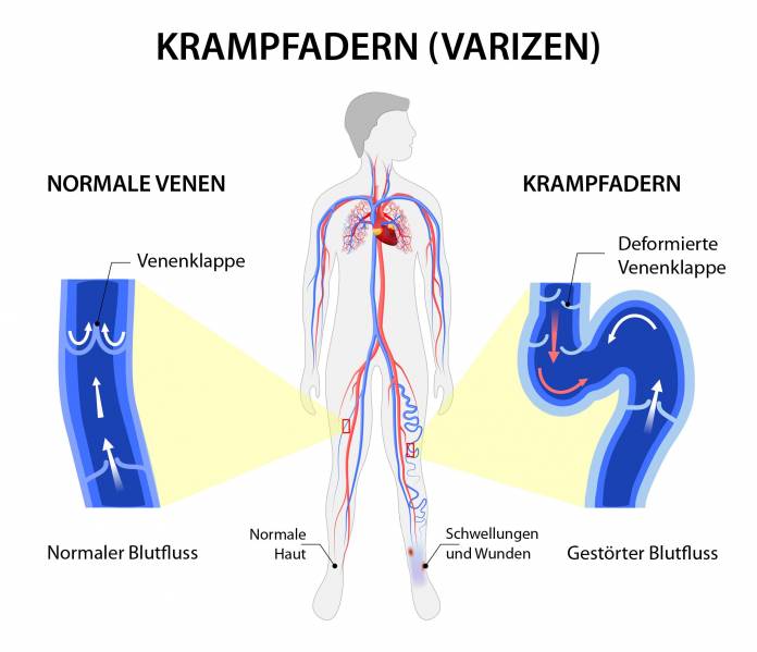 Krampfadern (Varizen)