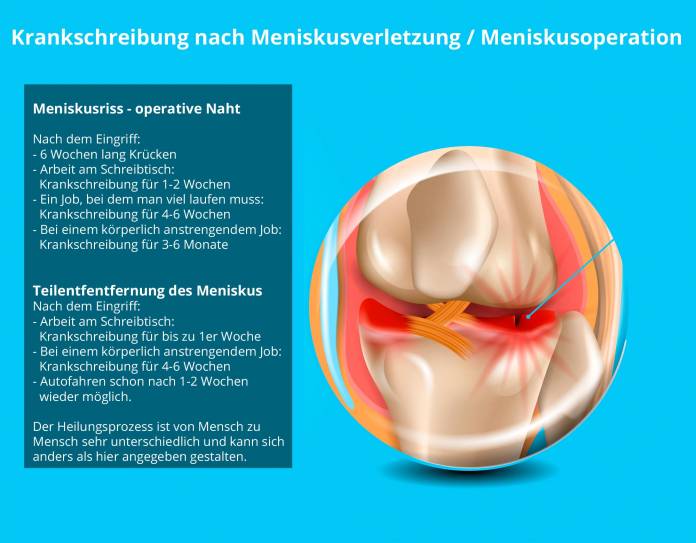 Krankschreibung nach Meniskusoperation