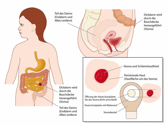 Künstlicher Darmausgang, Stoma