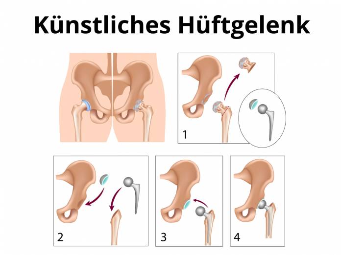 Künstliches Hüftgelenk