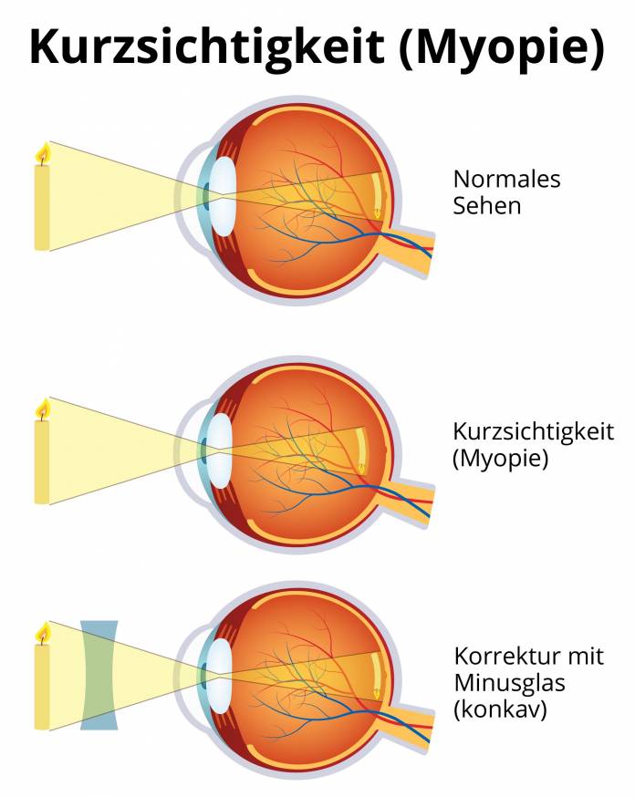 Kurzsichtigkeit (Myopie)