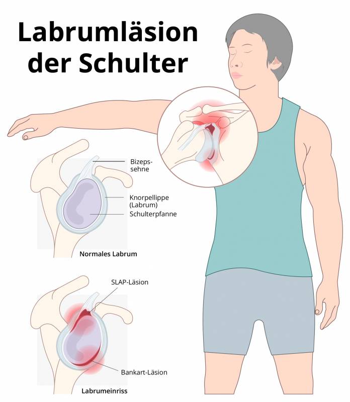 Labrumeinriss (Labrumläsion) Schulter