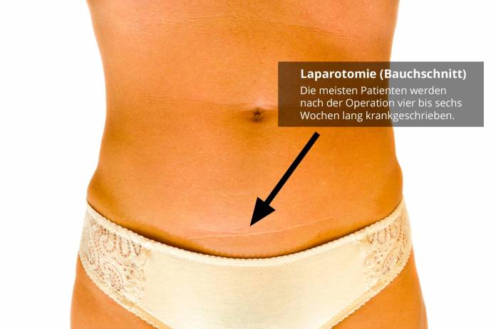 Laparotomie Krankschreibung