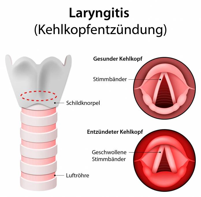 Laryngitis (Kehlkopfentzündung)