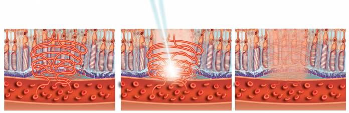 Laserkoagulation bei feuchter AMD