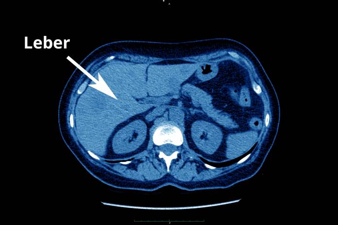 Lebermetastasen Ursachen Optimale Behandlung