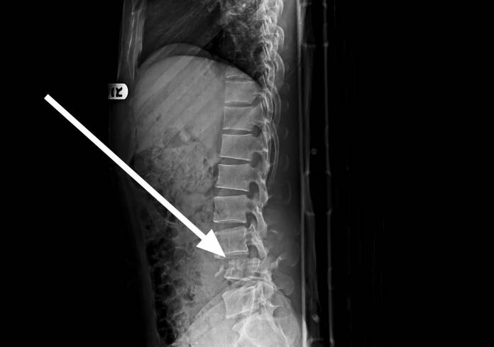Röntgenbild einer Lendenwirbelfraktur