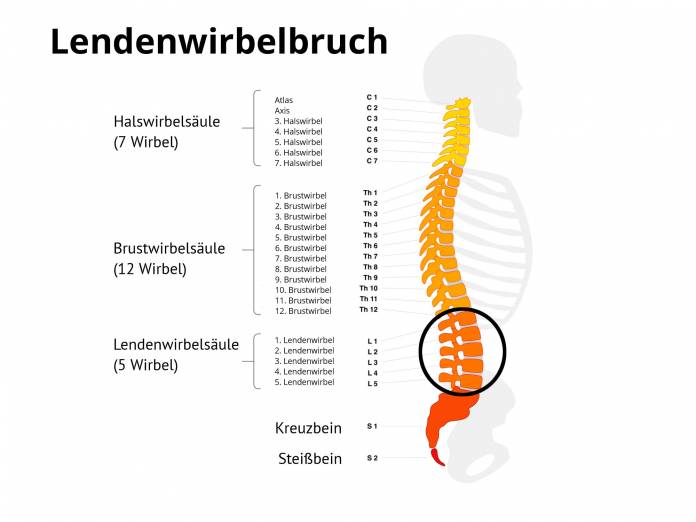 Lendenwirbelbruch