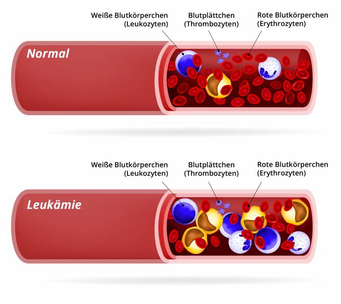 Leukämie (Blutkrebs)