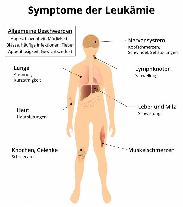 Symptome der Leukämie
