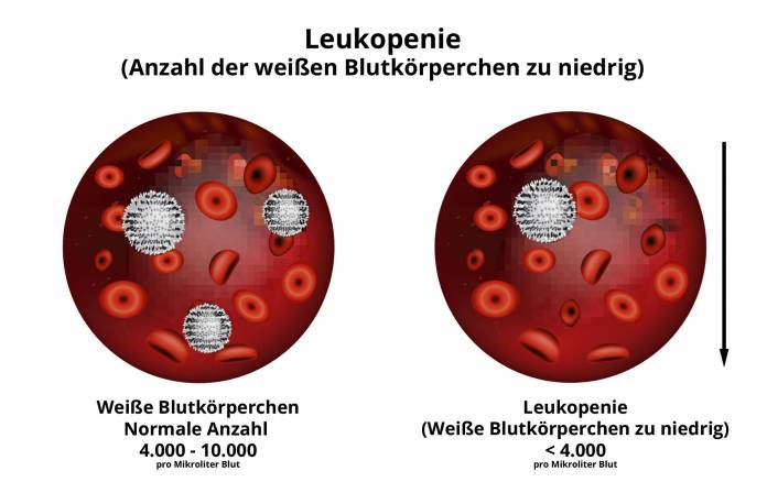 Leukopenie - Leukozyten zu niedrig