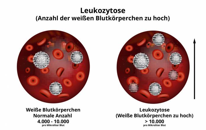 Leukozytose