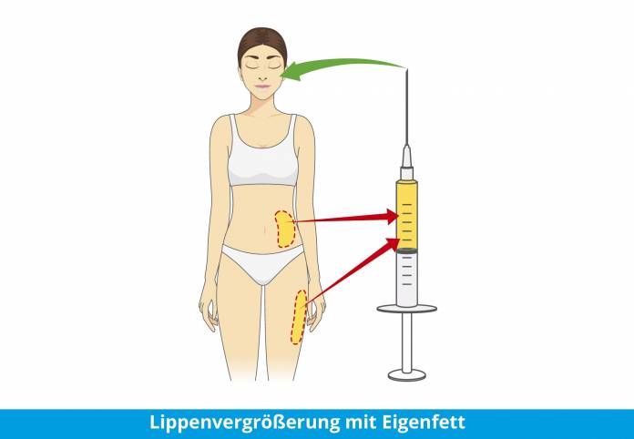 Lipofilling