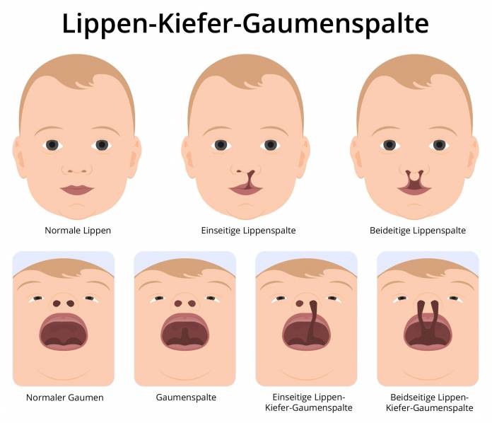 Lippen-Kiefer-Gaumenspalte
