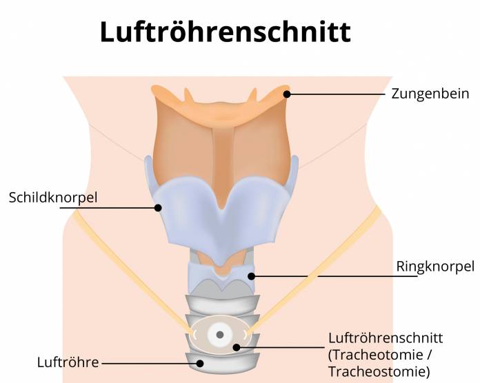 Luftröhrenschnitt