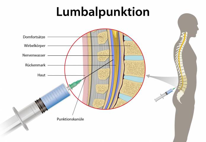 Lumbalpunktion