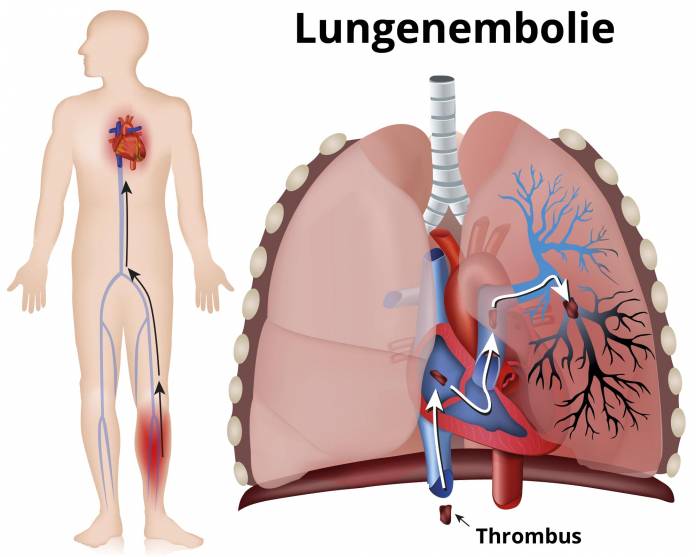 Lungenembolie