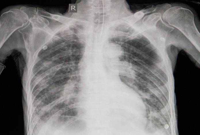 Röntgenaufnahme von Lungenödem
