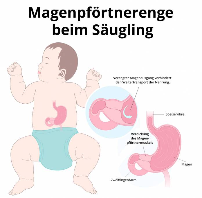 Magenpförtnerenge beim Kind (Säugling)