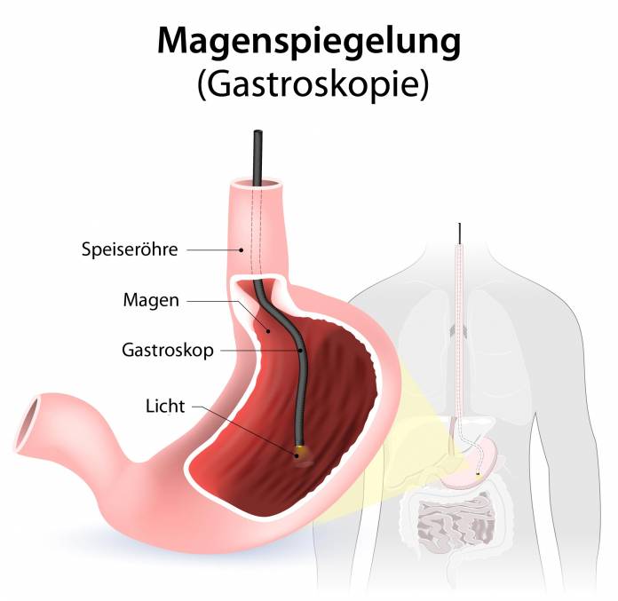 Magenspiegelung (Gastroskopie)