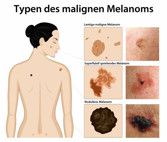 Typen des malignen Melanoms