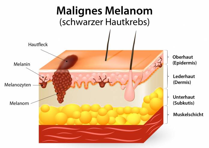 Malignes Melanom (schwarzer Hautkrebs)