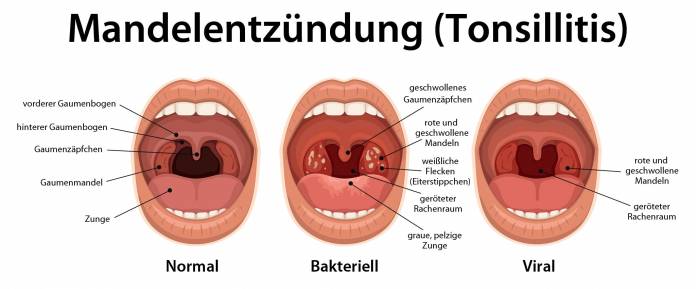 Mandelentzündung (Tonsillitis)