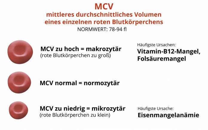 MCV