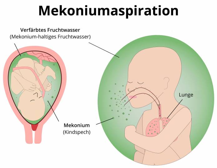 Mekoniumaspiration