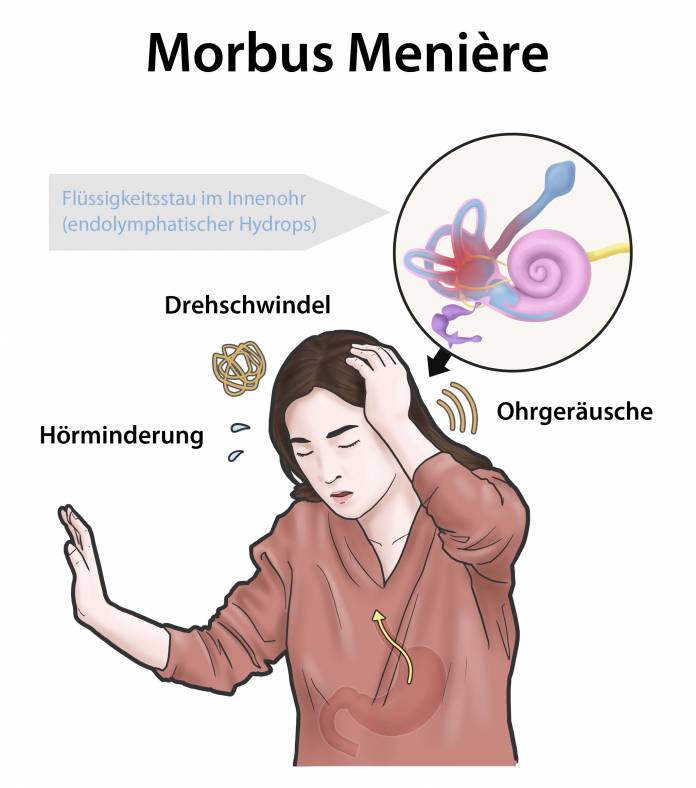 Symptome und Ursachen einer Meniére-Krankheit