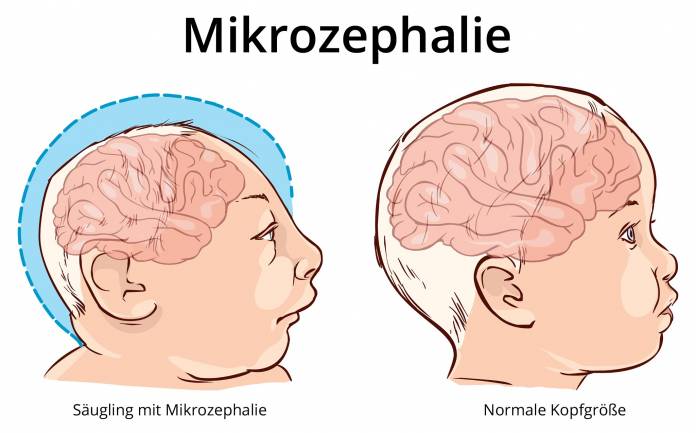 Mikrozephalie