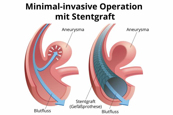Minimalinvasive Operation bei Aneurysma (Stentgraft)