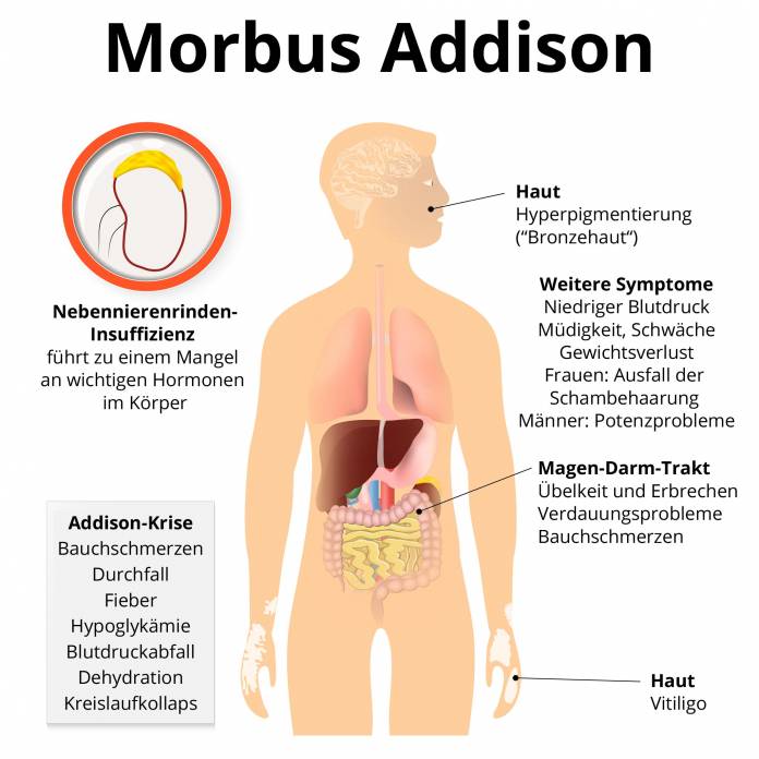 Morbus Addison Symptome