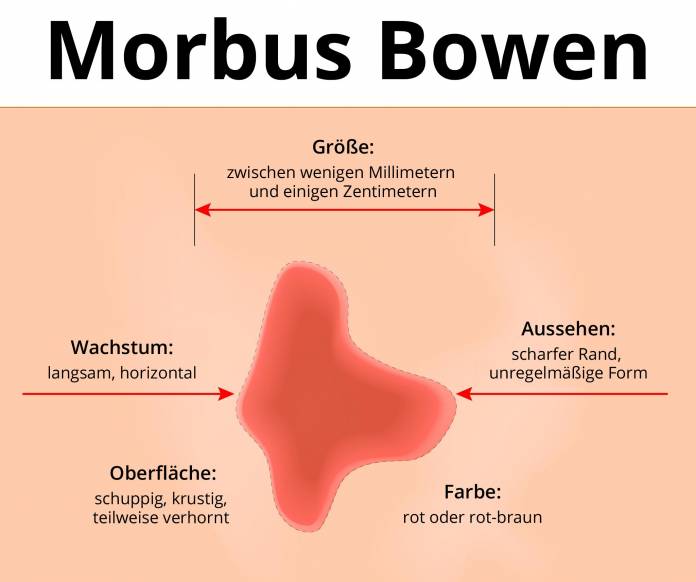 Morbus Bowen