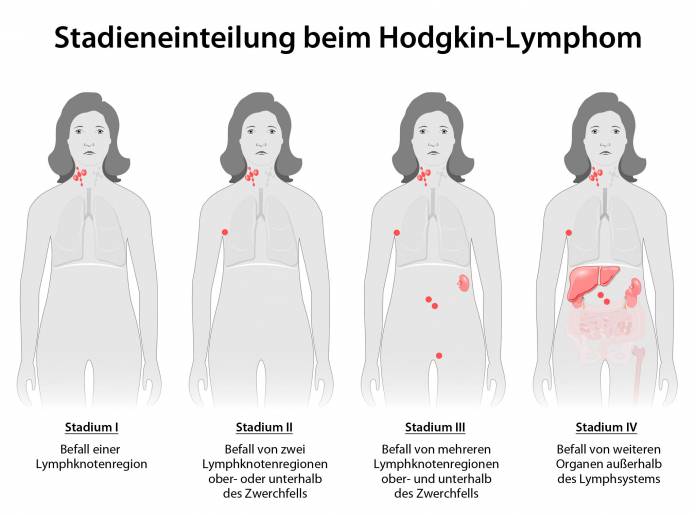 Morbus Hodgkin-Lymphom Stadien