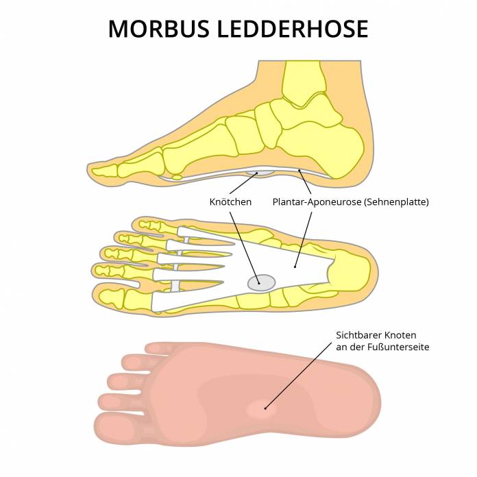 Morbus Ledderhose