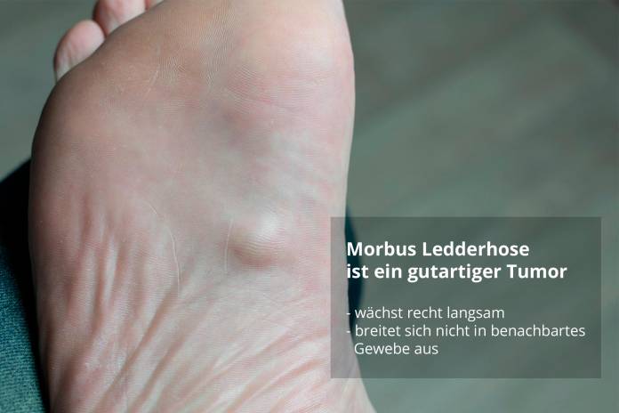 Morbus Ledderhose am Fuß