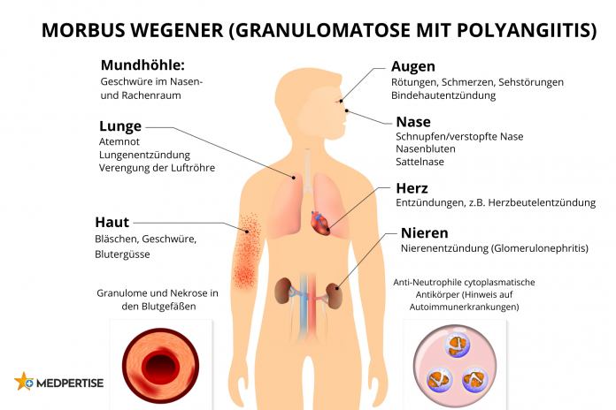 Symptome von Morbus Wegener