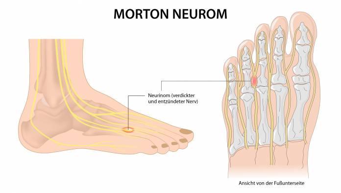 Morton Neurom