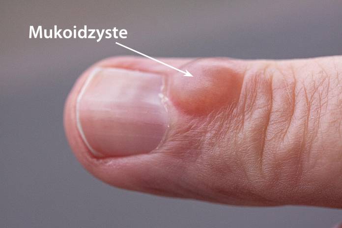 Was ist eine Mukoidzyste?