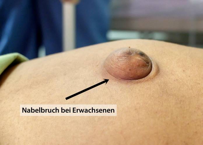 Nabelbruch bei einem Erwachsenen