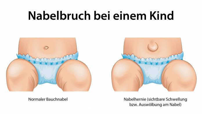 Nabelbruch bei einem Kind