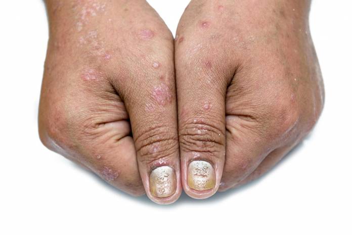 Nagelpsoriasis